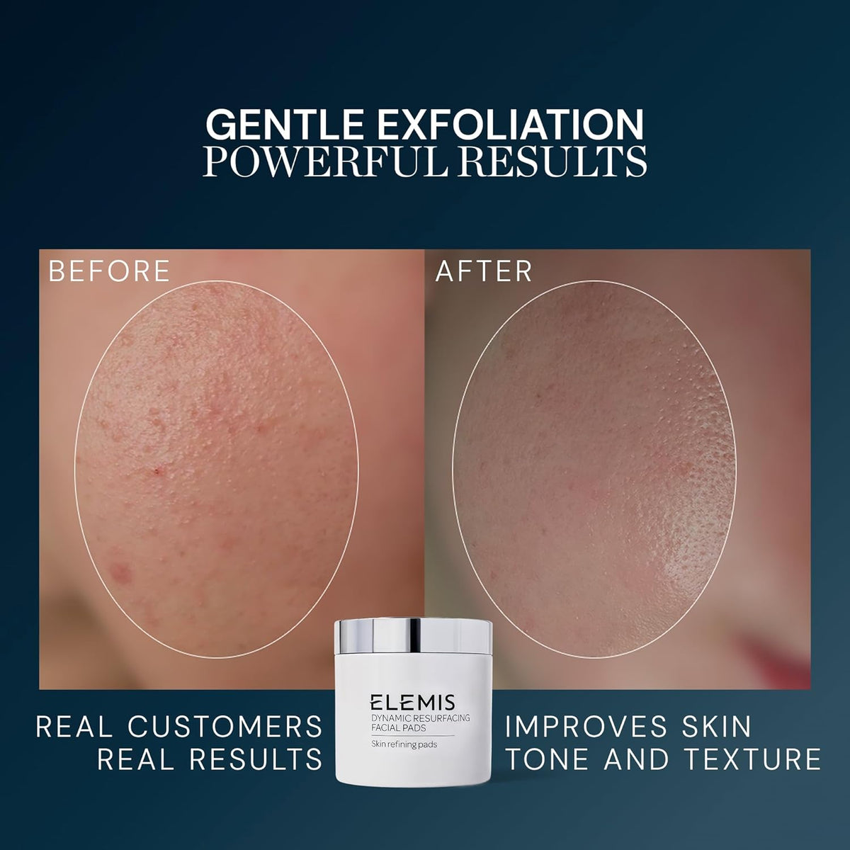 ELEMIS Dynamic Resurfacing Facial Pads, Gentle Textured Treatment